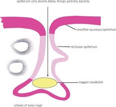 Image result for Tonsillolith