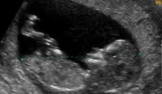 Aunque todavía faltan meses para que nazca el bebé, tus pechos han comenzado ya a fabricar calostro. Semana 13 De Embarazo Inatal El Embarazo Semana A Semana