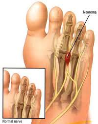The padded heel and metatarsal has eliminated the severe pain i was experiencing in my toes and the ball of my foot. Neuroma Surgery In Nyc Top Foot Doctor Podiatrist In Midtown Nyc