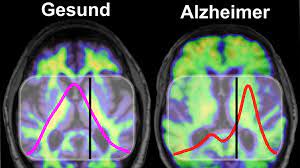 Demenz Fruherkennung Ein Bluttest Verrat Das Alzheimer Risiko Br Wissen