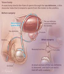 Vasectomy In This Jama Patient Page Researchers Describe The Vasectomy Procedure And Follow Up Practices Va Vasectomy Nursing Procedures Medical Knowledge