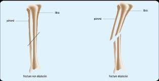 La plupart des fractures surviennent lorsqu'un os subit plus de force ou de pression qu'il ne peut en. Qu Est Ce Qu Une Fracture De La Jambe Ameli Fr Assure