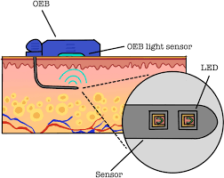 Bis heute , seit feb. Clinical Evaluation Of A Novel Subcutaneous Lactate Monitor Springerlink