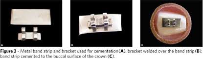 We did not find results for: Scielo Brasil Assessment Of The Mechanical Properties Of Glass Ionomer Cements For Orthodontic Cementation Assessment Of The Mechanical Properties Of Glass Ionomer Cements For Orthodontic Cementation
