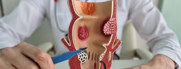 Image result for hemorrhoids