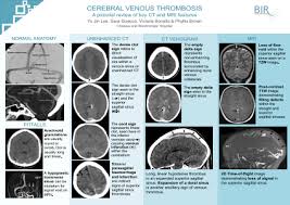 Risk factors, presentation, diagnosis and outcome. Eposters Cerebral Venous Thrombosis A Pictorial Review Of Key Ct And Mri Features