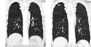 A pet scan, which uses a small amount of radioactive material, can help show if an enlarged lymph node is cancerous and detect cancer cells throughout the body that may not be seen on a ct scan. A Case Of Primary Lung Cancer Lesion Demonstrated By F 18 Fdg Positron Emission Tomography Computed Tomography Pet Ct One Year After The Detection Of Metastatic Brain Tumor