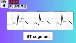 Image result for ST Segment