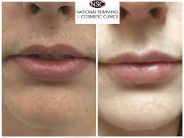 Laser hair removal uses laser light pulses that selectively destroy hair follicles by targeting the melanin in them. 7 Laser Hair Removal Before And After Ideas Laser Hair Removal Hair Removal Laser