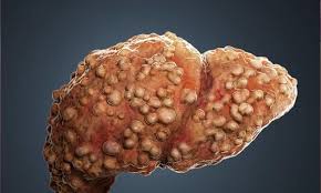 Loại rau này' được mệnh danh là “Vua hại gan”, hại hơn cả uống rượu, nhưng nhiều người vẫn mua về ăn