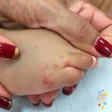 Image result for Scabies