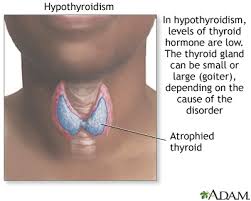 Thyroid problems such as hypothyroidism and hyperthyroidism are related to the use of checkpoint immunotherapies such as opdivo and keytruda in cancer patients more often for example, she said, renal cell carcinoma patients commonly take a kinase inhibitor that can also cause thyroid dysfunction. Hypothyroidism Medlineplus Medical Encyclopedia