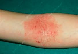 Image result for Atopic Patient