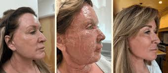 Two Weeks to Radiance: Helen's CO2 Laser Journey