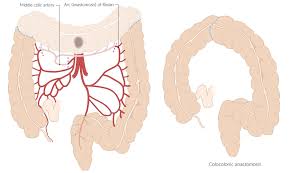 Mild to moderate diarrhea may occasionally persist for weeks to months after surgery, and some cats may have recurrent constipation. Colorectal Cancer Amboss