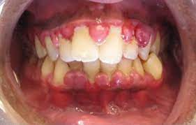 Inflammation of the gums, characterized by redness and swelling. Gingivitis Wikipedia