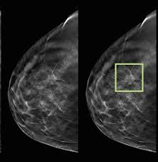Breast cancer breast cancer is the second leading cause of cancer in women. The Benefits Of 3d Mammograms Wayne Unc Health Care Goldsboro North Carolina