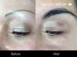An eyebrow transplant is a cosmetic procedure where hair grafts are transferred to your brow area. Eyebrow Hair Transplantation In Toronto Spamedica