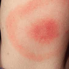 La maladie de lyme est causée par la bactérie borrelia burgdorferi. La Maladie De Lyme Pharmacie Principale
