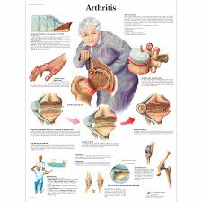 Arthritis Chart
