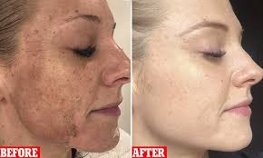 During this phase, the hair might be more noticeable and perhaps appear darker or thicker — but it's not. Why Women Should Consider Getting Their Face Shaved Shaving Face Shave Face Women Woman Shaving