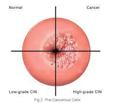 The virus, which causes most cases of cervical cancer, can also occur in women around menopause. Cervical Cancer Cancer Association Of Namibia Wo30