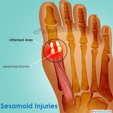 Sesamoid Injuries Gezond