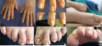 Image result for Yellow nail syndrome feet