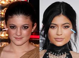 Here's what kylie jenner looked like before veneers. Kylie Jenner Before After Surgery