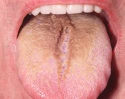 Image result for black hairy tongue symptoms