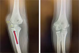 Image result for Lateral Condyle Fracture