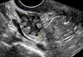 Image result for corpus luteum sonography)