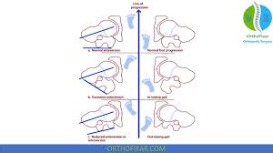 Image result for Foot Progression Angle