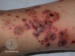 Image result for Vasculitis