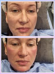 🌟Microneedling is an effective treatment for addressing fine lines,  under-eye bags, puffiness, hyperpigmentation, acne scars, and stretch  marks. When applied under the eyes, it can help reduce the appearance of  dark circles,