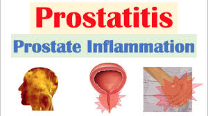 Image result for Acute Bacterial Prostatitis