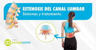 La estenosis del canal cervical produce ausencia de menstruación y dolor abdominal cíclico. Que Es La Estenosis Del Canal Lumbar Sintomas Y Tratamiento