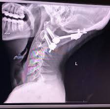 Image result for Lower Cervical Intramuscular Injection