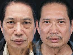 Lower Blepharoplasty By Dr Andrew Choi Vipplastics Losangeles Plastic Surgery Eyelid Surgery Cosmetic Surgery