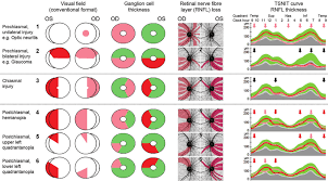 Image result for Visual Field Deficit