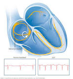 Image result for what is svt of the heart treatment