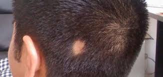 Alopecia areata is an autoimmune disease that leads to hair loss. Ø£Ø³Ø¨Ø§Ø¨ Ø§Ù„Ø«Ø¹Ù„Ø¨Ø© ÙˆØ¹Ù„Ø§Ø¬Ù‡Ø§ Ù…ÙˆØ¶ÙˆØ¹