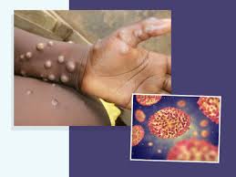 The public health department needs to be informed of a monkeypox infection. Monkeypox Symptoms Causes Diagnosis Treatment