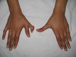 Research suggests that poland syndrome is three times more common in males than in females. Poland Syndrome Hand Orthobullets