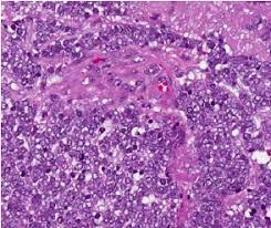 Primary site histology staging type; B Histology Of Merkel Cell Carcinoma Download Scientific Diagram