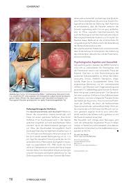 From wikipedia, the free encyclopedia. Die Therapie Der Vaginal Und Uterusaplasie Rosenfluh Ch