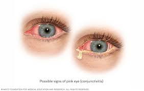 Image result for Conjunctivitis