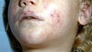Your medical team will try to stop the infection, keep your organs working, and manage your. Sepsis In Infants Children Healthychildren Org