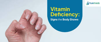 Image result for Vitamin Deficiency
