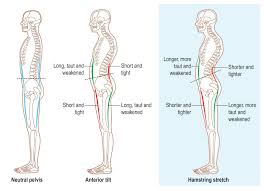 Welcome back to squat university! Workouts To Prevent Back Pain Hamstring Injury Anterior Pelvic Tilt